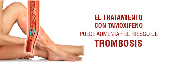 El tratamiento con tamoxifeno puede aumentar el riesgo de trombosis